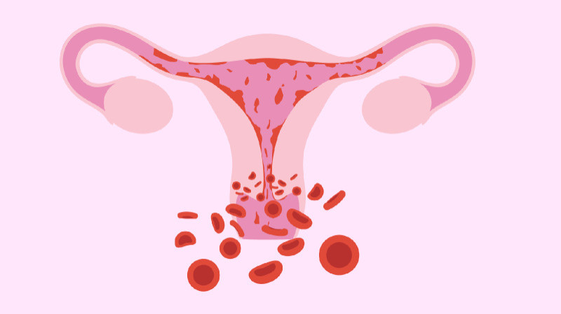 Understanding Menorrhagia